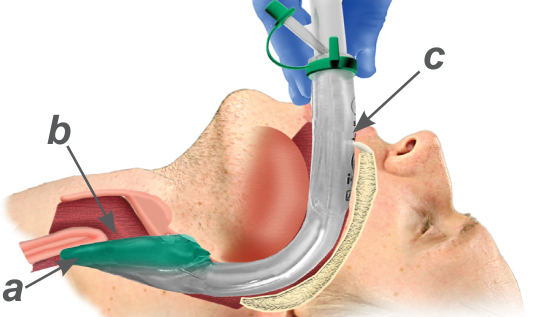 Dibuix d'un cap d'un home en posició horitzontal que ens mostra un dispositiu i-gel correctament inserit en la via aèria superior. Un mà amb un guant blau subjecta el dispositiu que entra a la boca del pacient. Una fletxa retolada amb la lletra c ens assenyala els incisius del pacient. Baixant dins la cavitat bucal veiem com el dispositiu es corba seguint la base de la llengua cap a la retrofaringe fins a quedar perpendicular a l'obertura bucal. La part distal de la i-gel, de color verd i més aviat plana, es troba enfrontada a l'entrada de la laringe. Una fletxa retolada com a b assenyala l'orifici de la i-gel. L'extrem distal d'aquesta i-gel es troba obturant l'entrada de l'esòfag a la faringe, una fletxa, retolada amb l'a, l'assenyala.