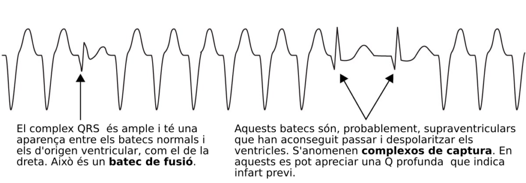 Tira de ritme d'un electrocardiograma que mostra bàsicament un traç de complexos amples i alts. En el tercer complexe, també una mica ample, però menys que els altres i més baix, una fletxa ens porta a un text que diu: "El complex QRS és ample i té una aparença entre els batecs normals i els d'origen ventricular, com el de la dreta. Això és un batec de fusió." Els següents sis complexos són idèntics als dos primers, els dos següents tenen una morfologia diferent, més estrets i baixos, més semblants a un complexe supraventricular normal. Un parell de fletxes ens porten al text següent: "Aquests batecs són, probablement, supraventriculars que han aconseguit passar i despolaritzar els ventricles. S'anomenen complexos de captura. En aquests es pot apreciar una Q profunda que indica infart previ." Els següents tres complexes són com els primers