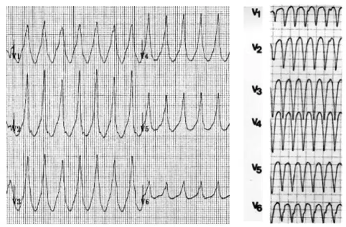 Dues fotografies d'un traçat electrocardiogràfic de derivacions precordials. En la imatge de l'esquerra tots els complexes són amples en la seva base (> de 3mm, 120ms, d'amplada) i totes les derivacions són totalment positives. En la imatge de la dreta també són amples però els complexos són totalment negatius