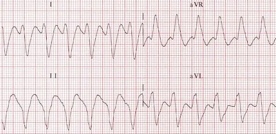 Registre electrocardiogràfic de les derivacions D.I, D.II, VR i VL, em que podem apreciar que a VR hi ha una ona R (positiva) prominent, mentre a D.II és un complex QS (negatiu, sense ona R) molt marcat. Tant D.I i VL mostren un complex rS majoritàriament negatiu