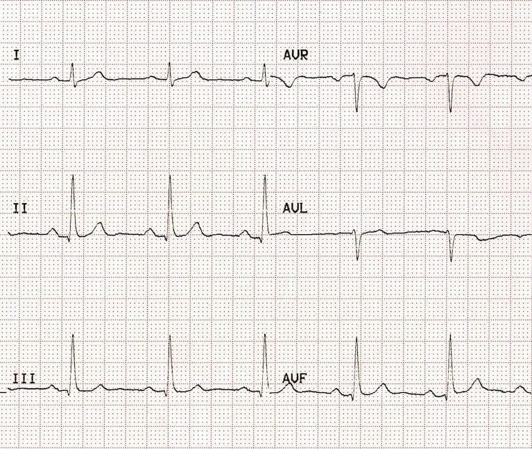 ECG de derivacions frontals normal