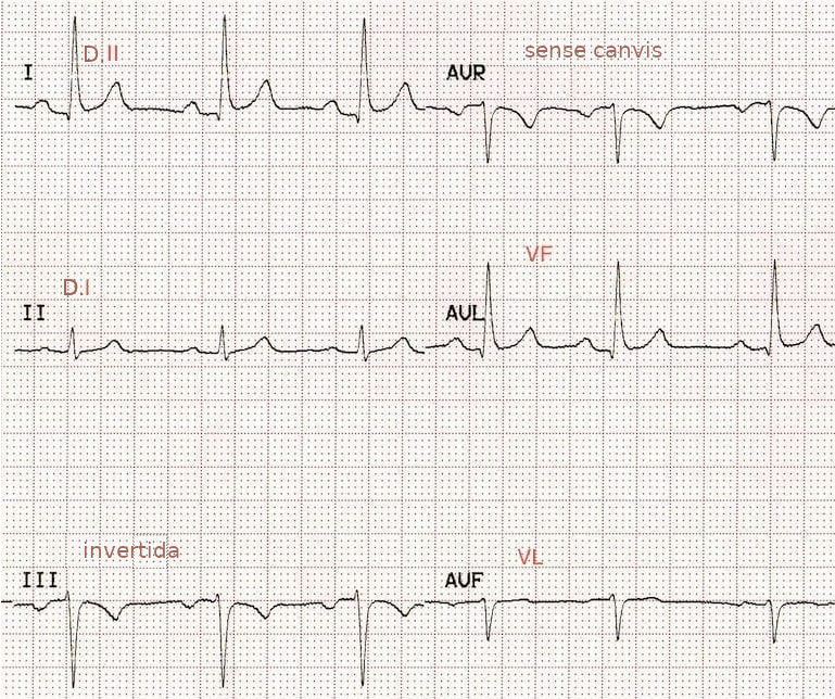 ECG de derivacions frontals amb inversió de braç esquerre a cama esquerra