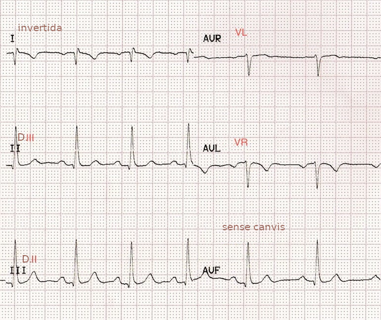 ECG de derivacions frontals amb inversió de braç dret a braç esquerre
