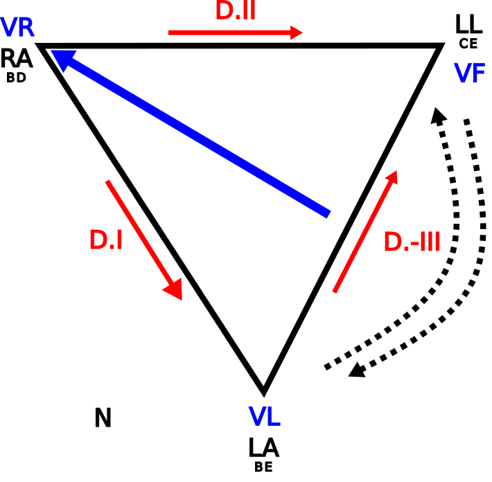 Triangle d'Einthoven mostrant inversió dels elèctrodes LA i LL