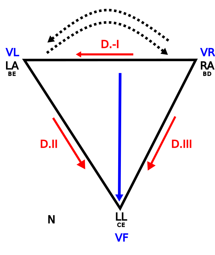 Triangle d'Einthoven mostrant inversió dels elèctrodes LA i RA