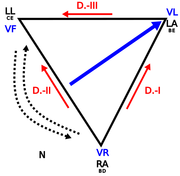 Triangle d'Einthoven mostrant inversió dels elèctrodes RA i LL