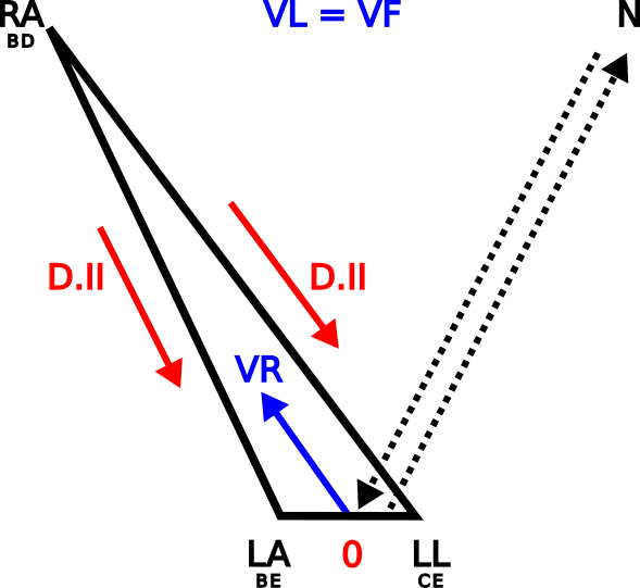 Triangle d'Einthoven mostrant inversió dels elèctrodes LA i RL