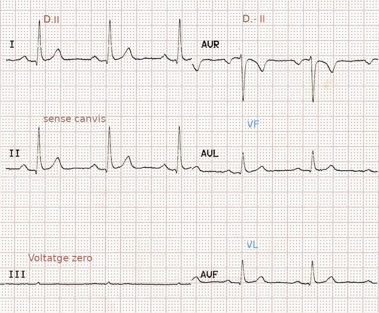 ECG de derivacions frontals amb inversió de braç esquerre a cama dreta