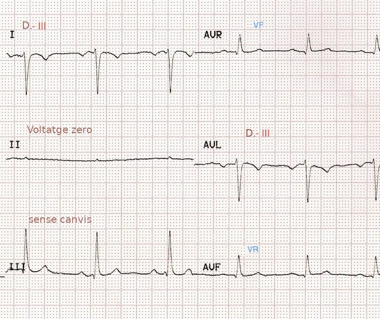 ECG de derivacions frontals amb inversió de braç dret a cama dreta