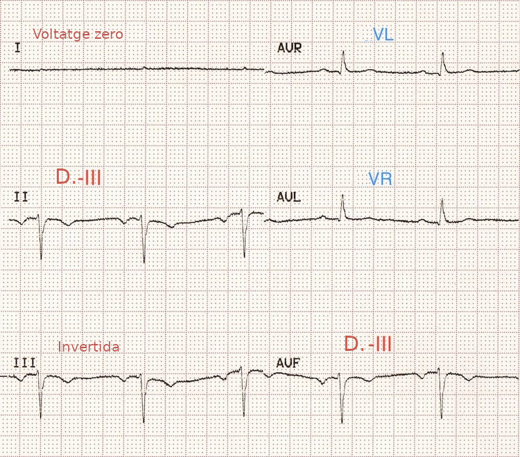 ECG de derivacions frontals amb inversió bilateral de braços i cames