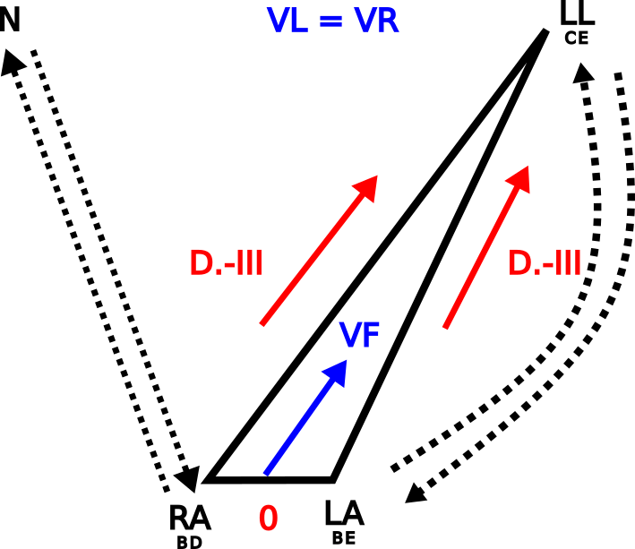 Triangle d'Einthoven mostrant inversió dels elèctrodes LA i RL