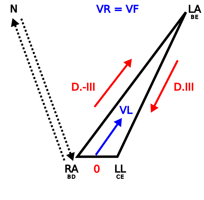 Triangle d'Einthoven mostrant inversió dels elèctrodes RA i RL