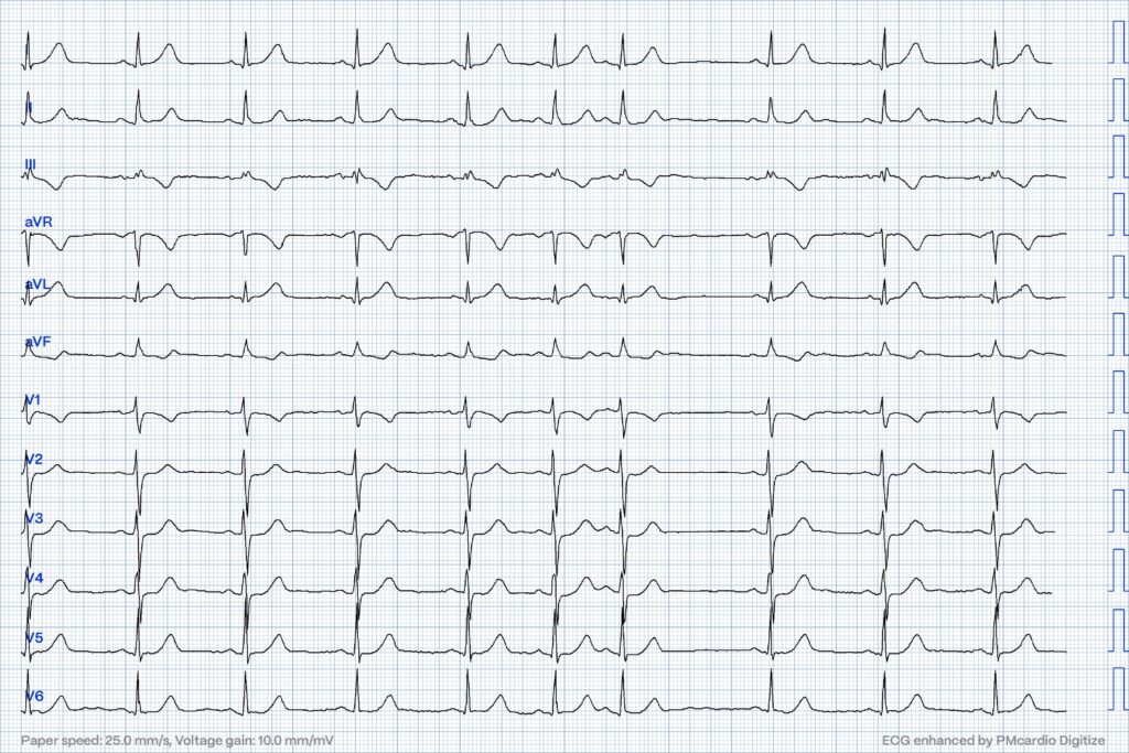 Electrocardiograma que mostra T invertides a D.III i vF, ST descendit de V2 a V4 i ones T hiperagudes a D.I i vL