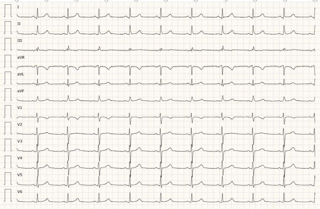 ECG d'un pacient al que li ha cedit el dolor toràcic