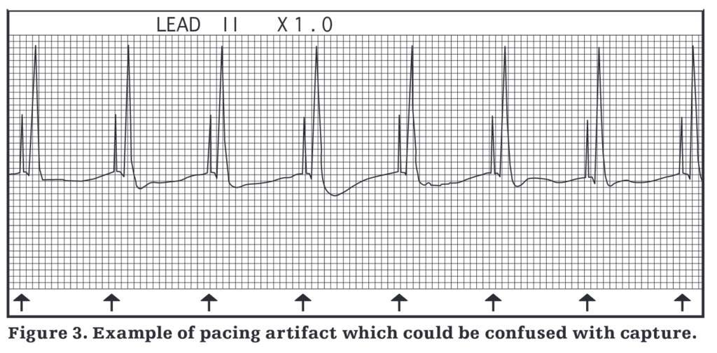 Tira d'electrocardiograma que mostra espícules de marcapassos seguides d'un complex QRS