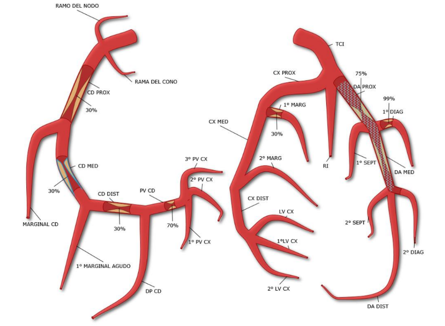 Diagrama de l'anatomia d'artèries coronàries. Cal destacar l'oclusió de la 1a diagonal al 99% i del 75% a terç proximal i medial de la DA, a la que se li ha posat un stent