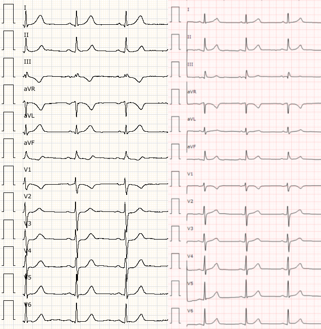 Dos ECG d'un mateix pacient comparats