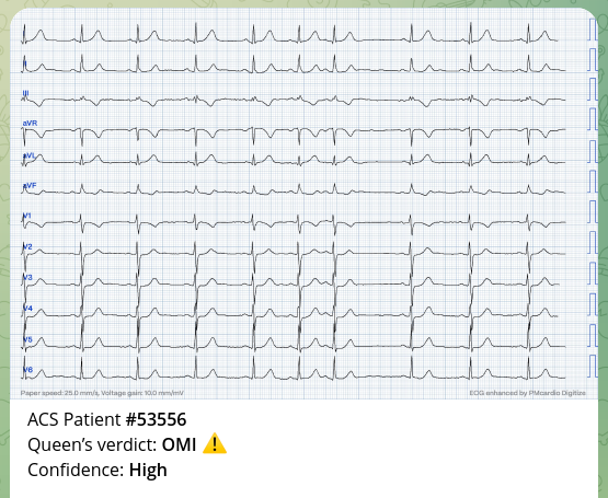 Captura de pantalla de l'aplicació Queen of Hearts que mostra un electrocardiograma. Hi anota el veredicte d'oclusió coronària amb alta confiança