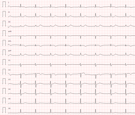 ECG d'un pacient després de fer-li una angioplàstia